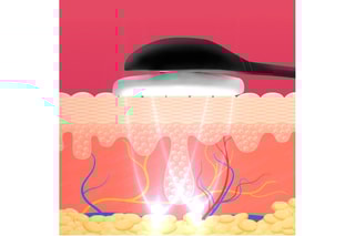 Appareil d'électrostimulation faciale EMS