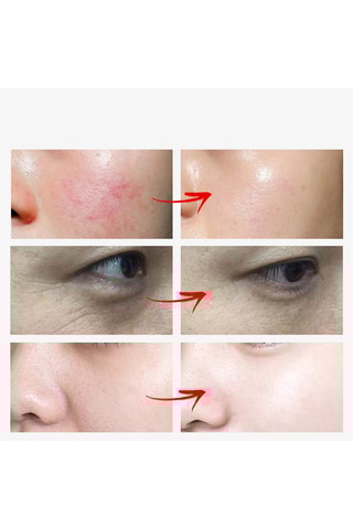 Pistolet électrique traitement de la peau