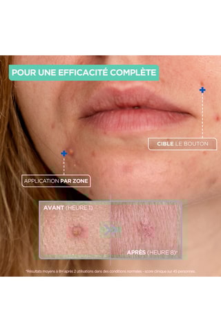 Geconcentreer Pasta Tegen Puistjes Mixa - Geschikt voor de gevoelige huid - 15 ml