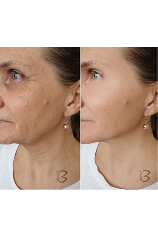 Huidverzorgingsapparaat Dermopen B-Meso - 5 snelheden