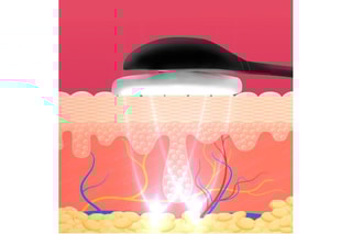 Apparecchio di elettrostimolazione facciale EMS