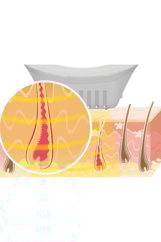 Epileerapparaat met Lichtflitsen