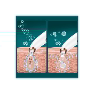 Extracteur de points noirs - Visage - Blanc