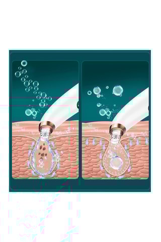 Extrator de pontos negros com pequenas bolhas X13 - Branco