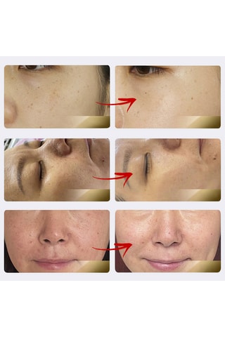 Appareil de photothérapie régénératrice - Visage
