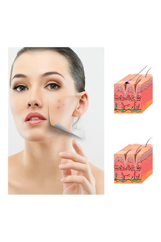 Stylo plasma pour le visage